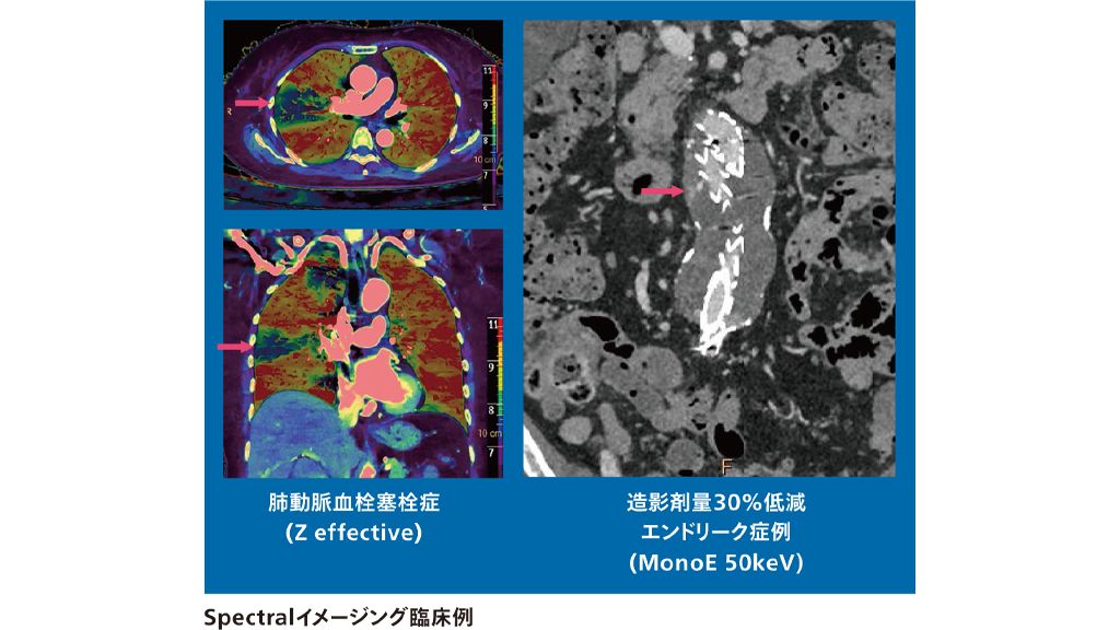 Spectralイメージング臨床例