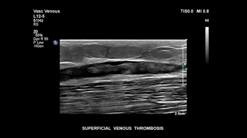 Superficial venous thrombosis