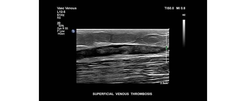Superficial venous thrombosis