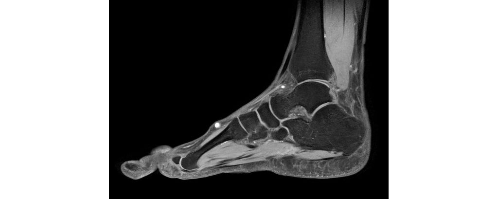 Sagittal mDIXON XD - T1w TSE (Water only)