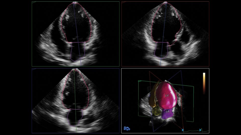 HeartModel clinical image