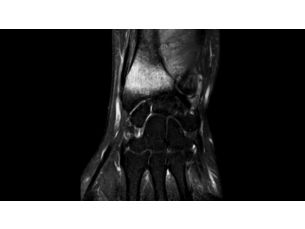 Compressed SENSE - MSK MR Clinical Applications