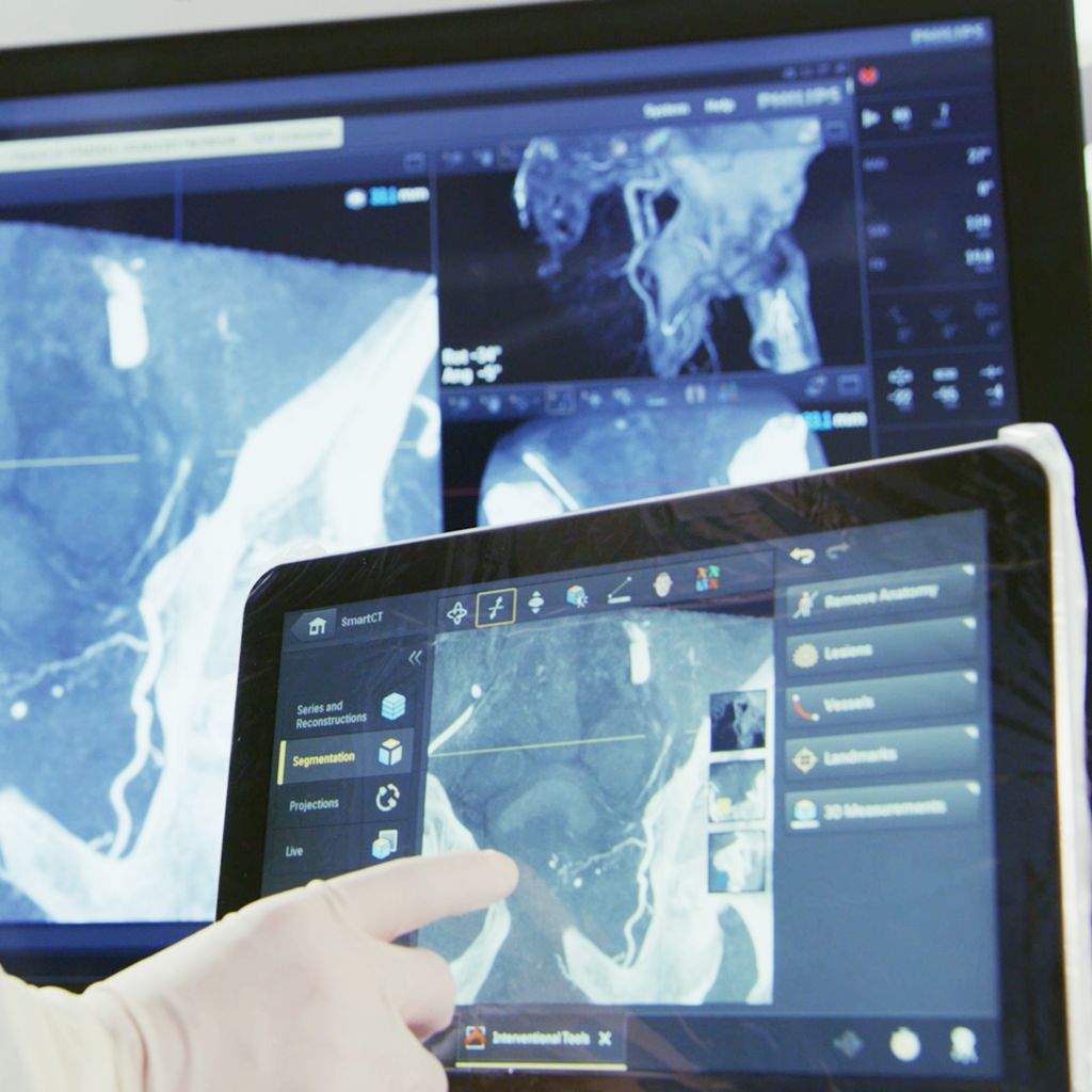 Azurion SmartCT Soft tissue