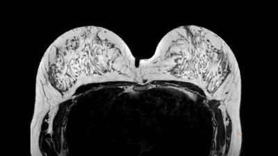 MRI 健康・医学 Breast