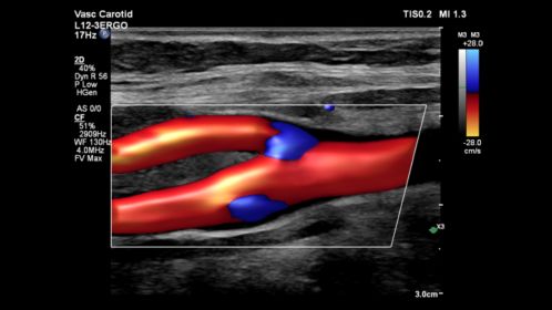 L12-3 ERGO Vascular Carotid Flow Viewer Color