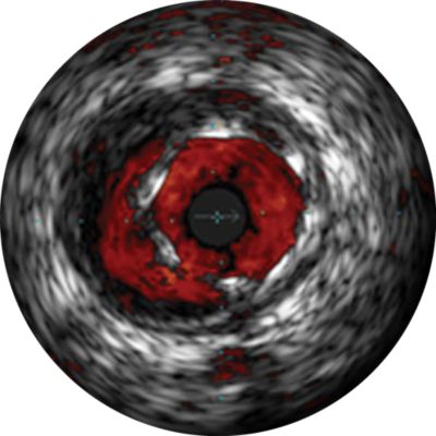 IVUS assessment of stent malapposition