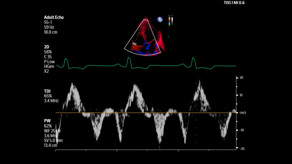 Adult echo Tissue Doppler Imaging with pulsed wave Doppler shown using S5-1 transducer.