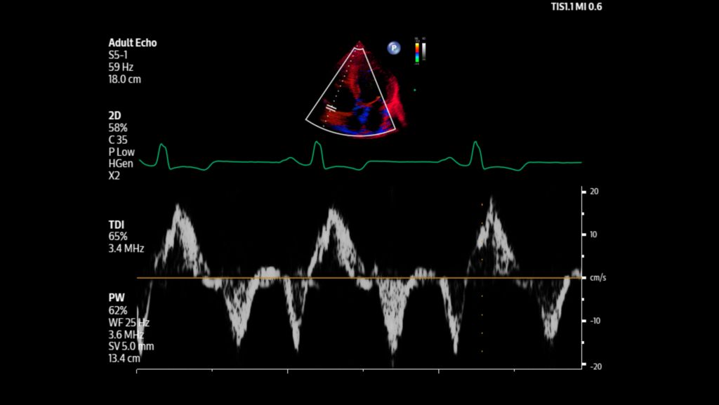 Adult echo Tissue Doppler Imaging with pulsed wave Doppler shown using S5-1 transducer.