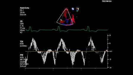 Adult echo Tissue Doppler Imaging with pulsed wave Doppler shown using S5-1 transducer.