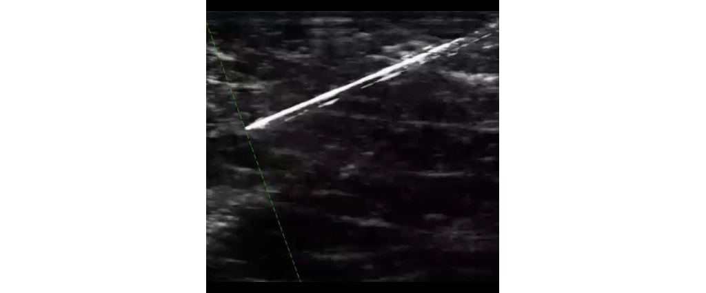 Visuzlize needles prominently