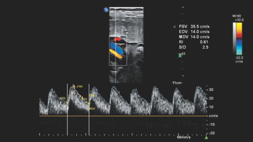 eL18-4 umbilical cord Doppler