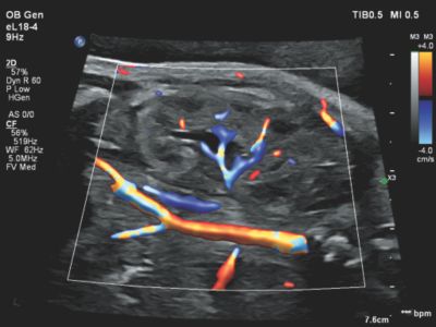 Flow Viewer applied to color flow with eL18-4 fetal kidney
