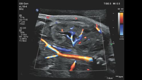 Flow Viewer applied to color flow with eL18-4 fetal kidney