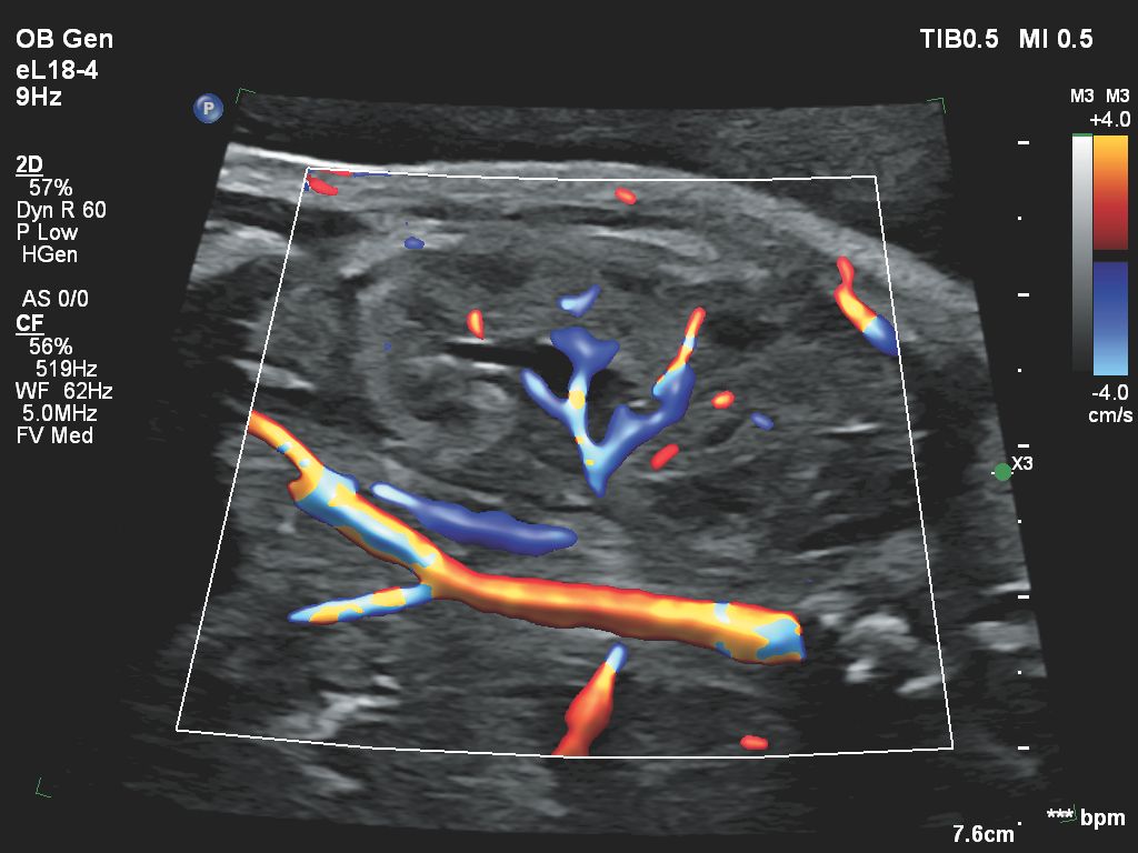 Flow Viewer applied to color flow with eL18-4 fetal kidney