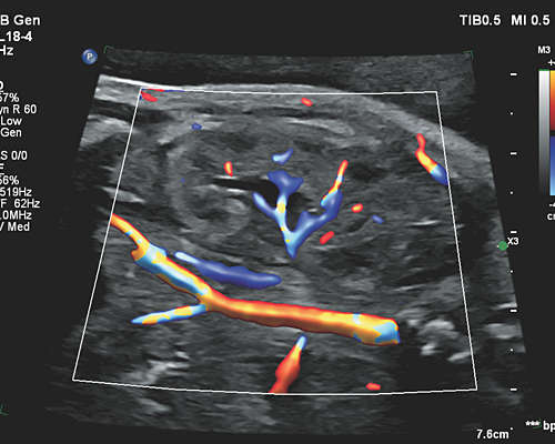 Flow Viewer applied to color flow with eL18-4 fetal kidney