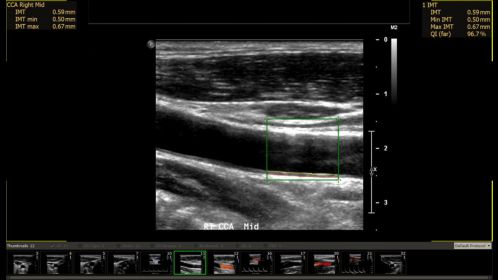 Ultrasound Workspace Vascular Measurement