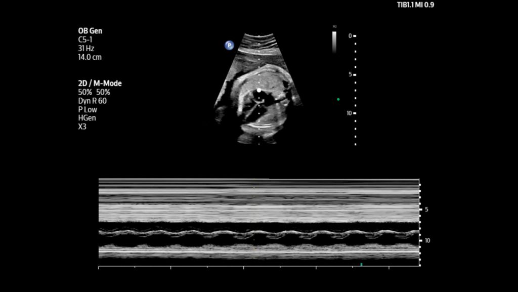 Fetal heart shown with M-mode using C5-1 transducer.