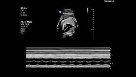 Fetal heart shown with M-mode using C5-1 transducer.
