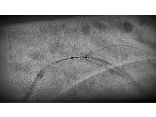 StentBoost Live See clearly, stent confidently