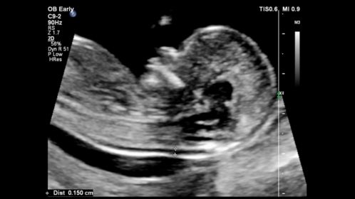 Fetal profile shown using C9-2 transducer