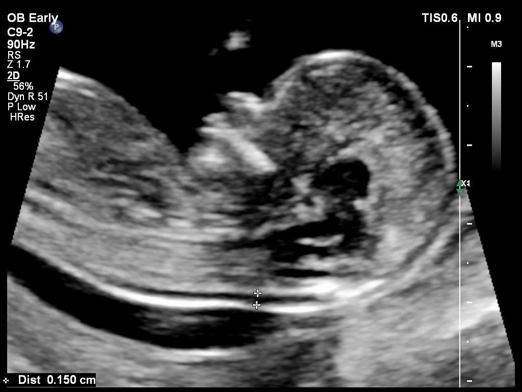 Fetal profile shown using C9-2 transducer