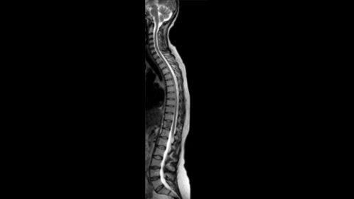 Sagittal T2w TSE mDIXON (In Phase)- Total Spine