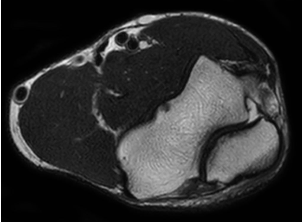 Axial T2w TSE - Elbow