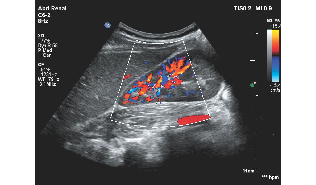 Affiniti 30 ultrasound clinical image abdominal