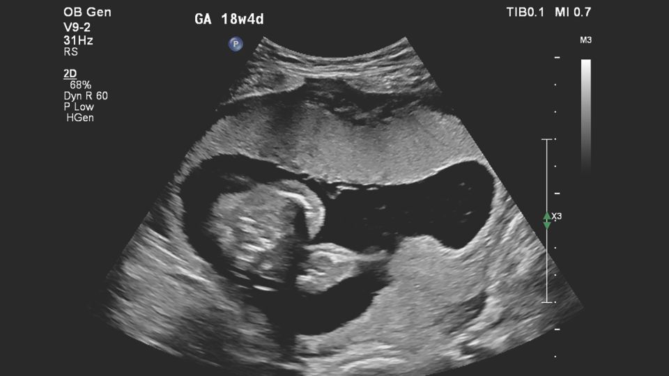 Figure 2 V9-2 transducer sagittal image of suspected placental abnormality