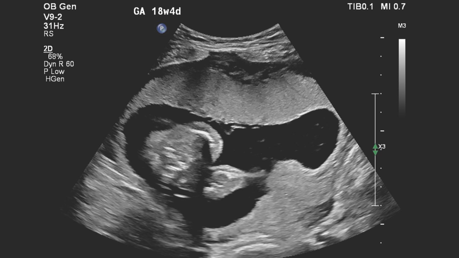 Figure 2 V9-2 transducer sagittal image of suspected placental abnormality