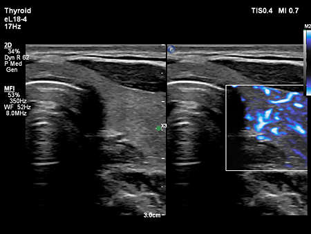 eL18-4 Thyroid with MicroFlow Imaging