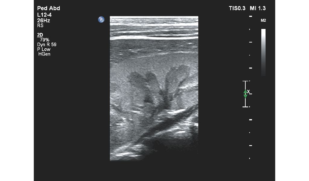 Affiniti 30 ultrasound clinical image  pediatric