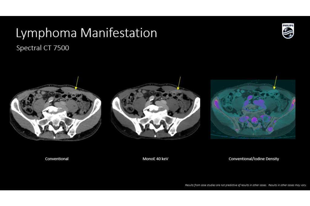 CT Spectral 7500 Lymphoma Manifestation