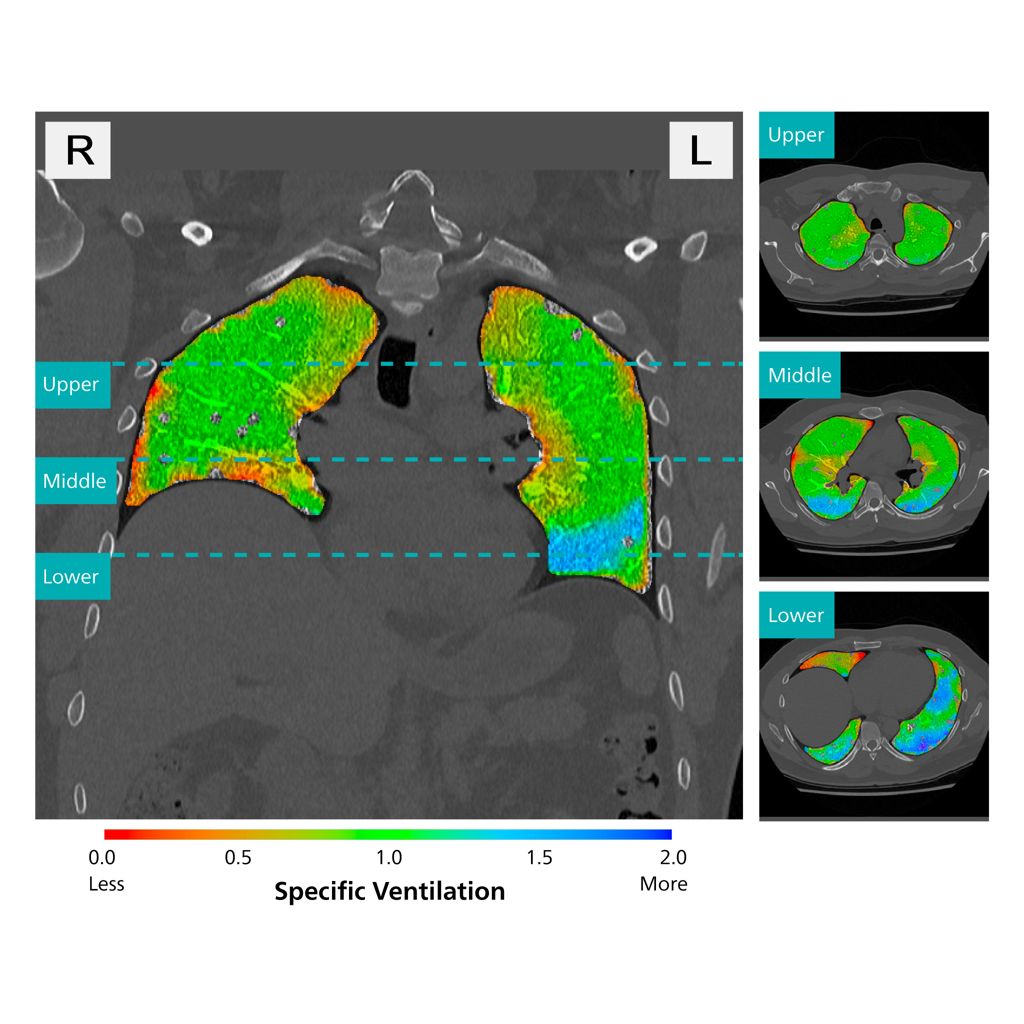 Regional lung function metrics for objective assessment