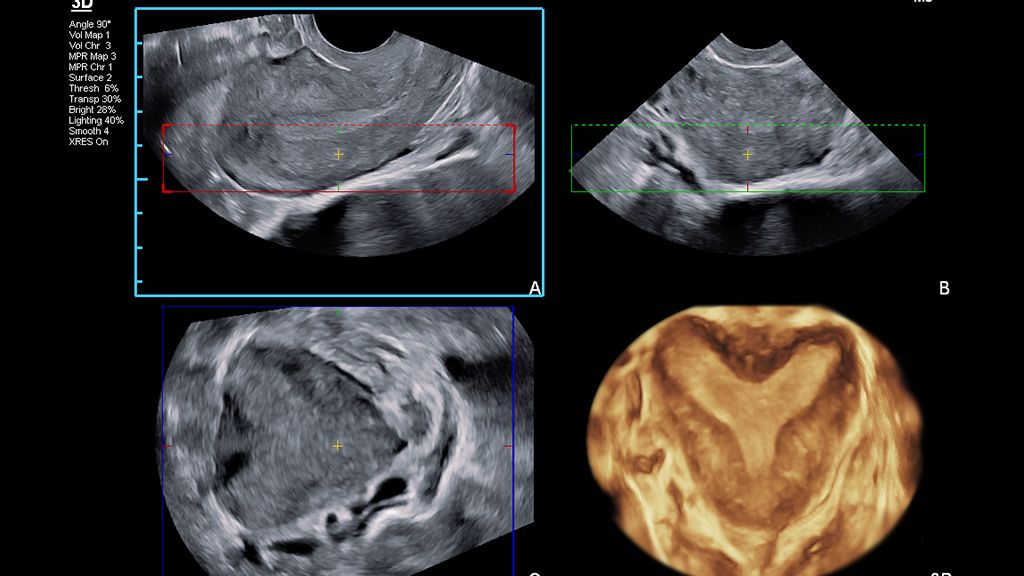 eV14-2v clinical image on EPIQ showing 3D bicornuate pelvis