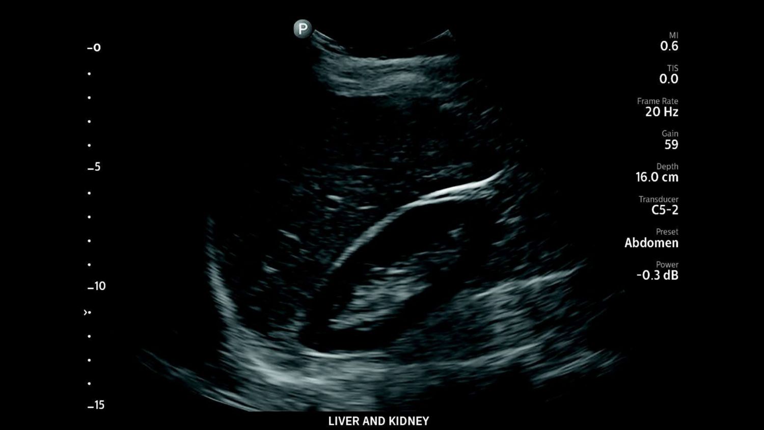 Abdominal ultrasound scan using Lumify