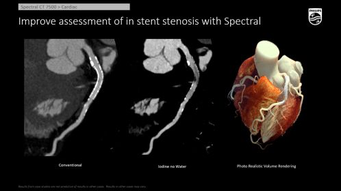 CT Spectral 7500 Cardiac Stent