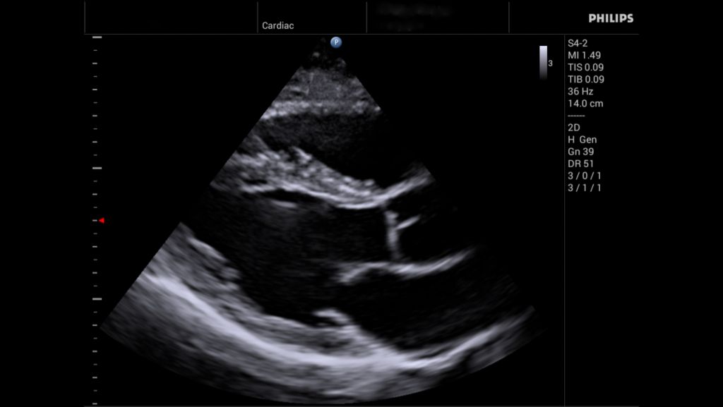 S4-2 Parasternal Long Axis