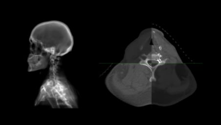 Rely on MRCAT-based patient positioning