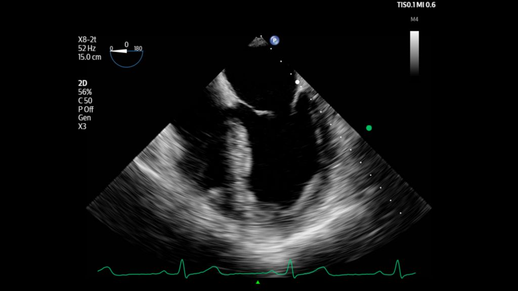 Left ventricle and mitral valve shown using X8-2t transducer on Flash 5100 POC