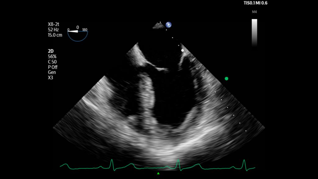 Left ventricle and mitral valve shown using X8-2t transducer.