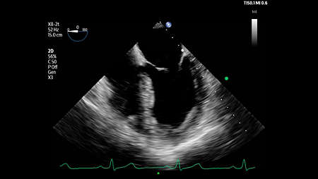 Left ventricle and mitral valve shown using X8-2t transducer.