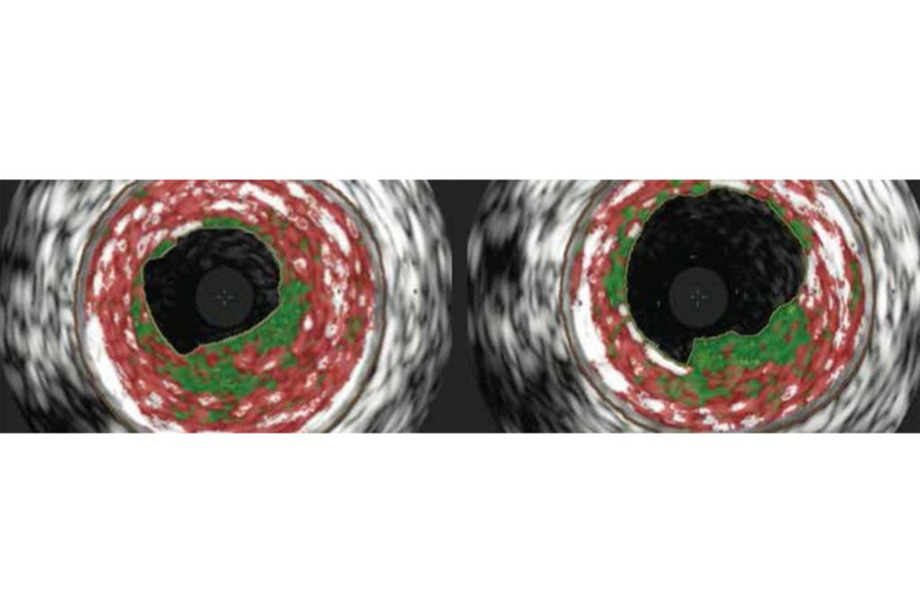 Maximal luminal gain¹, ³⁻⁶