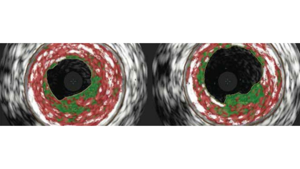 Maximal luminal gain¹, ³⁻⁶