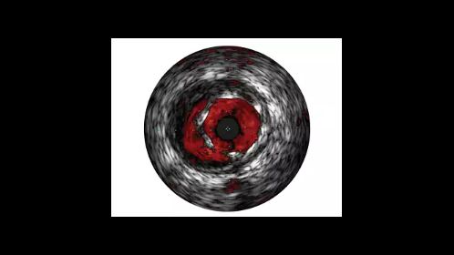 VH IVUS imaging