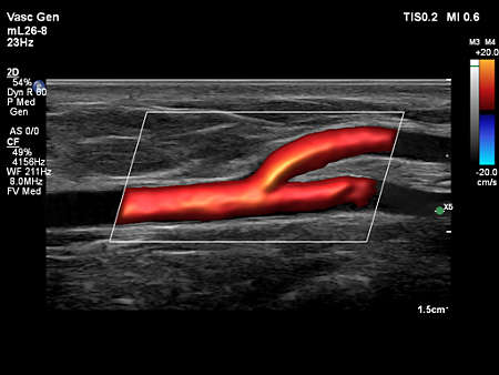 mL26-8 Superficial Artery with FlowViewer