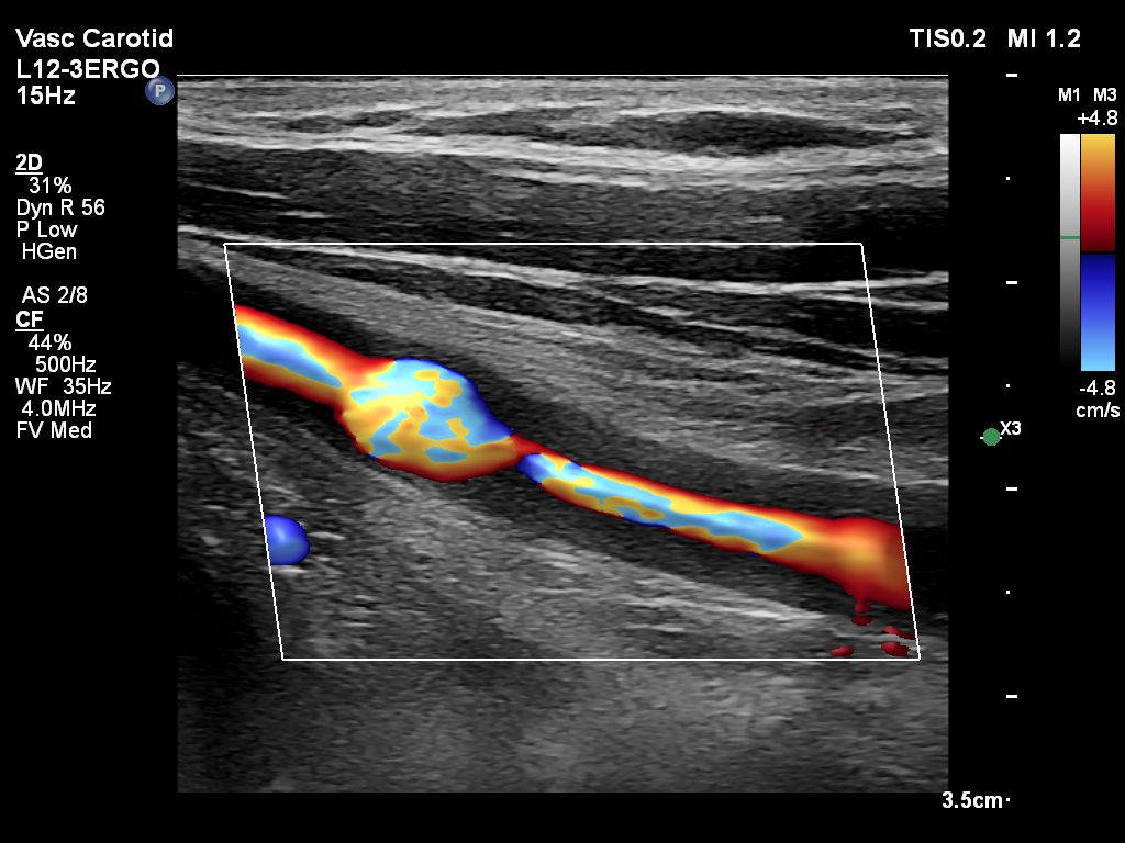 L12-3 Ergo paired with Flow Viewer, scanning on a carotid