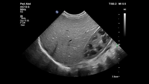 mC12-3 Pediatric Liver Kidney
