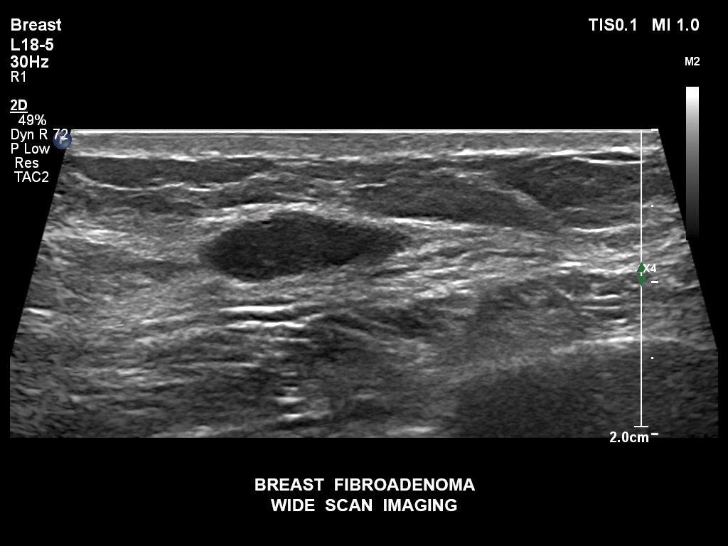 Breast fibroadenoma
