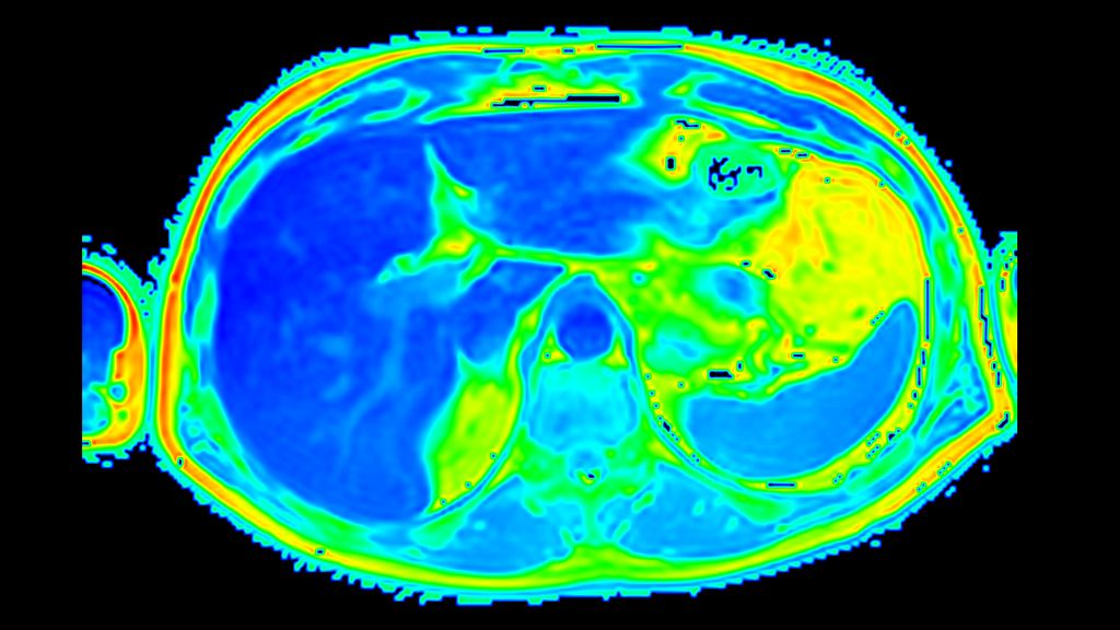Axial mDixon Quant Fat Fraction map
